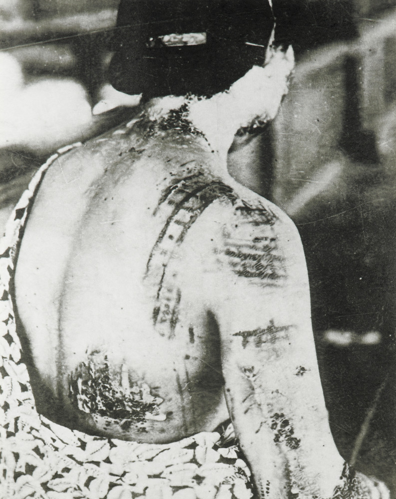 Gonichi Kimura, Motifs de kimono incrustés par brûlure dans la peau, premier hôpital militaire d'Hiroshima, vers le 15 août 1945